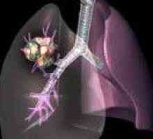 Adenokarcinom pljuč