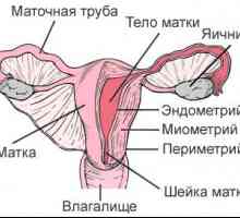 Adenomioza (endometrioze, materničnega telesa)