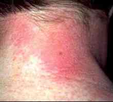 Alergijski dermatitis: Simptomi in zdravljenje