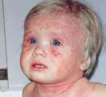 Atopijski dermatitis pri odraslih in otrocih