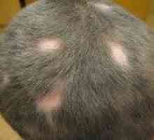 Alopecija pri otrocih