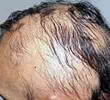 Alopecija