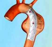 Anevrizma aortnega loka