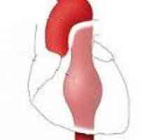 Anevrizma na padajoče prsne aorte