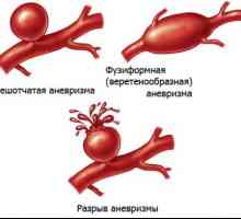 Ledvične anevrizma arterije