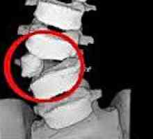 Anomalije hrbtenice