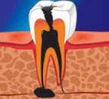 Apical periodontitis