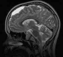 Arahnoidnih ciste možganov