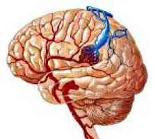 Arteriovenske malformacije možganov