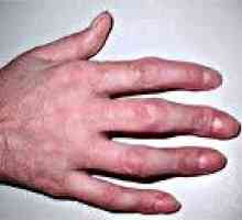 Prsti artritis