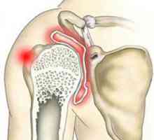 Artritis ramenskega sklepa