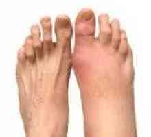 Artritis stopala