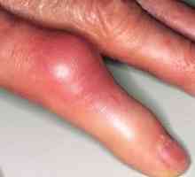 Artritis sklepov prstov