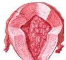 Neobičajni hiperplazija endometrija