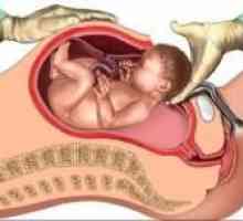 Nosečnost in porod z materničnega brazgotino po carskim, odstranjevanje fibroids