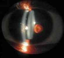 Biomicroscopy oči
