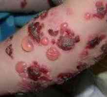 Bulozni dermatitis