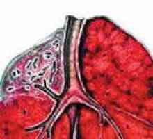 Cirozo pulmonalne tuberkuloze
