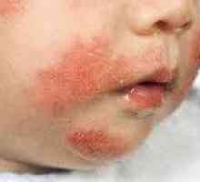 Dermatitis pri otrocih
