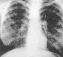 Difuzna pljučna fibroza