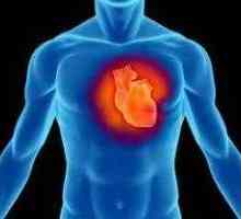 Dilatativna kardiomiopatija