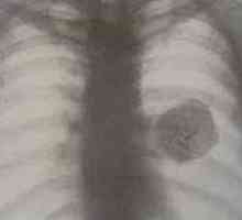 Benigni pljučni tumorji
