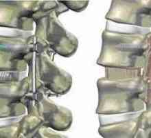 Hrbtenice fiksiranje v spondilolisteze, zmanjšanje višine medvretenčnih diskov