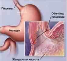 Gastroezofagealna refluksna bolezen (GERD)