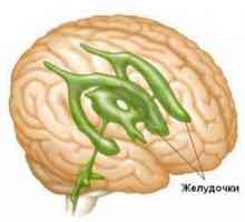 Možgani hidrocefalus pri odraslih