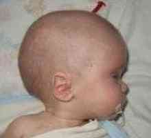 Hidrocefalus pri otrocih