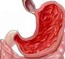Hiperplastični gastritis