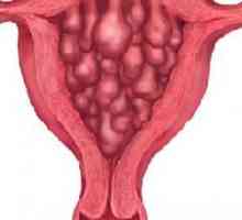 Hiperplazija endometrija