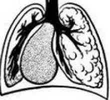 Hipoplaziji pljuč