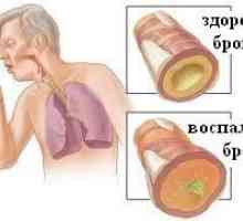 Kronični bronhitis