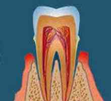 Kronični periodontitis