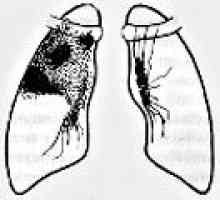 Infiltracijsko pljučno tuberkulozo