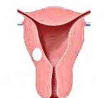 Vrinjeni fibroidi