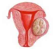Vrinjeni fibroidi