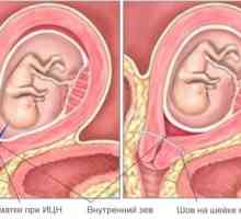 Materničnega vratu nesposobnost (CIN) med nosečnostjo