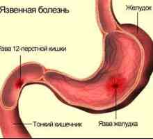 Razjede (peptičnega ulkusa), želodec in dvanajsternik