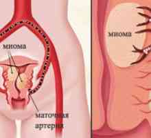 Maternične arterije embolizacija (EMA), materničnega mioma