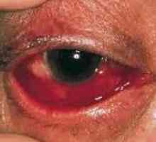 Epidemijah hemoragični konjunktivitis