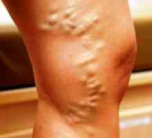 Kako za zdravljenje krčne žile na nogah