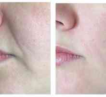 Kako odstraniti nosno-ustnične gube?