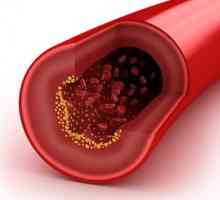 Kako zmanjšati raven holesterola v krvi?