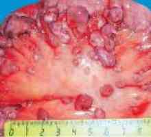 Peritonealno karcinomatoza