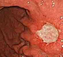 Karcinoidni tumorji gastrointestinalnega trakta