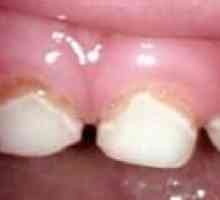 Zdravljenje primarnih zob