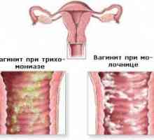 Coleitis (vaginitis) pri moških in ženskah