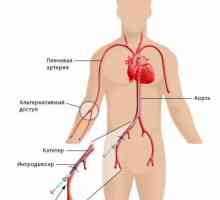 Koronarno angiografijo (koronarno)